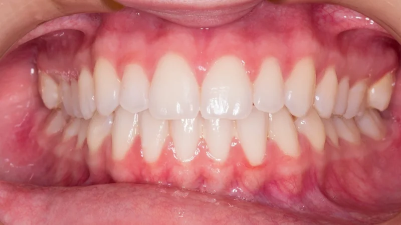 Wybielanie zębów: ile kosztuje u polskiego dentysty w UK?